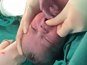 Bebê com 6 “dentes” surpreende, mas dentista explica equívoco
