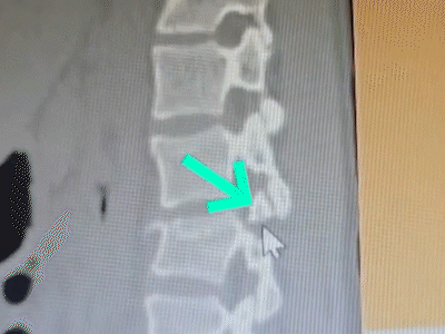 Maria foi fazer exame de sangue e acabou operada da coluna às pressas